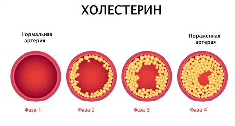 Высокий холестерин — в чем опасность — Полезная информация